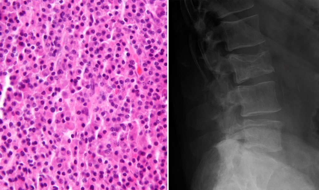 Το πολλαπλούν μυέλωμα είναι μία αιματολογική κακοήθεια που οφείλεται στον ανεξέλεγκτο πολλαπλασιασμό κυττάρων που παράγουν αντισώματα στον μυελό των οστών (Wikipedia/Miller School Of Medicin)