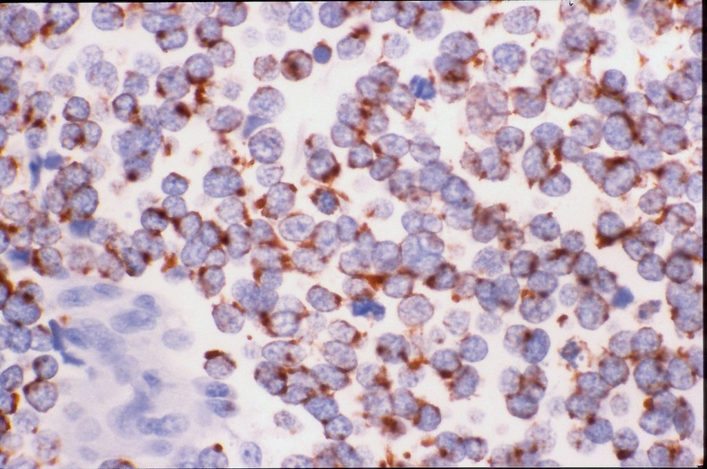 Το κουβανικό εμβόλιο κατά του καρκίνου που θέλουν και οι ΗΠΑ