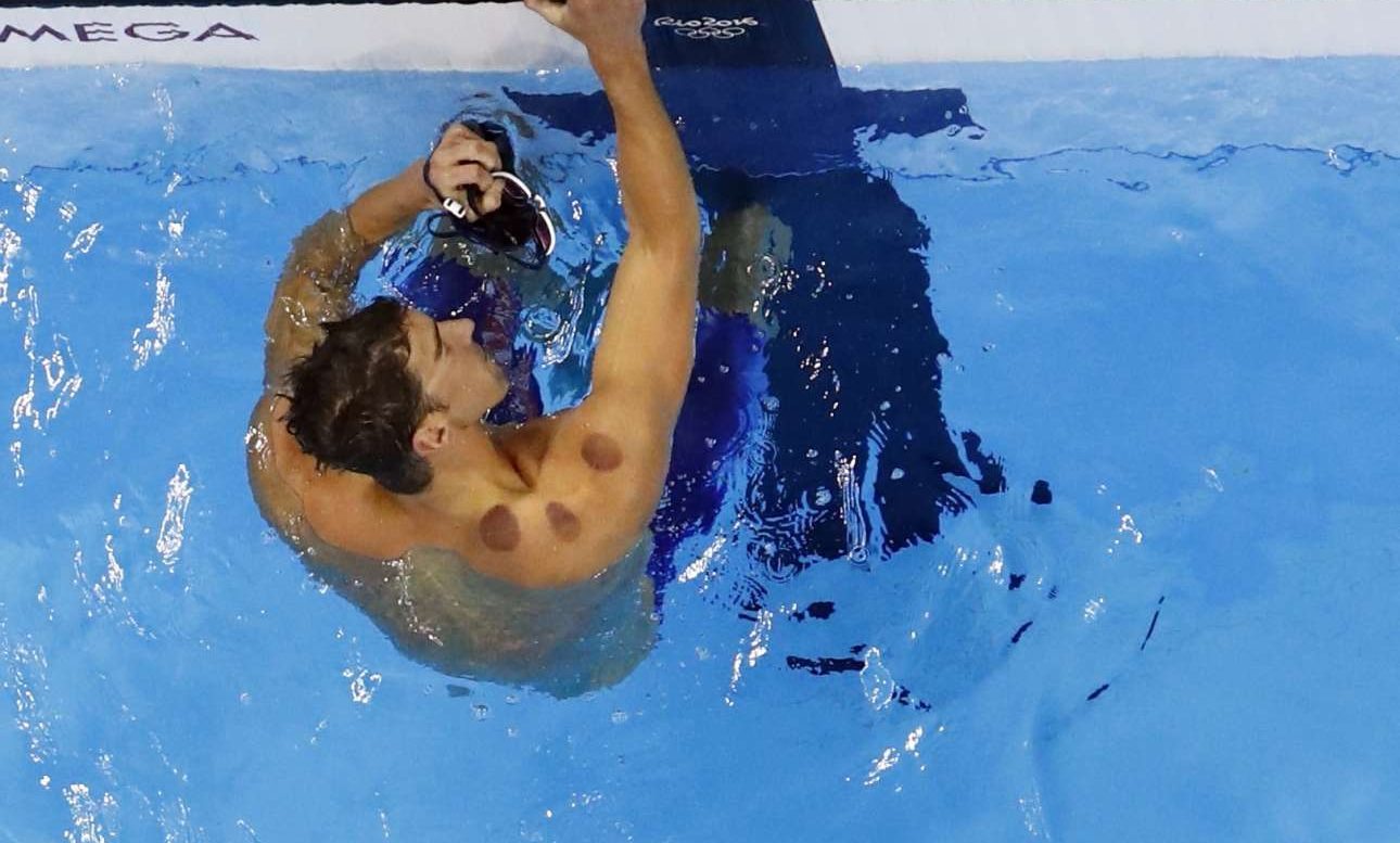 Γιατί οι αθλητές έχουν τόσες μελανιές;