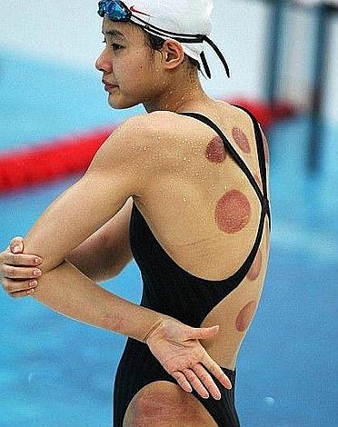 cupping_therapy2