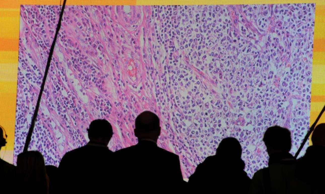 Ο καρκίνος θα χτυπήσει εκρηκτικά τις γυναίκες ως το 2030