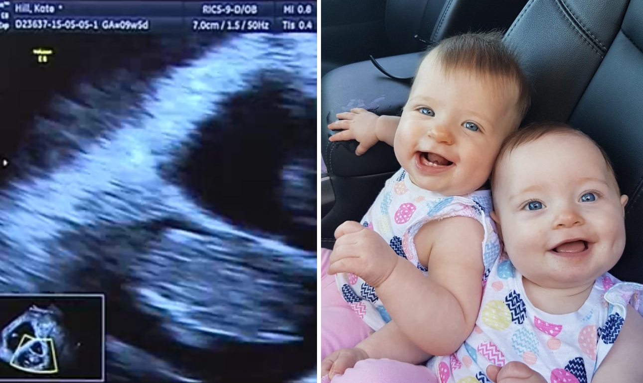 Πώς μια γυναίκα μένει έγκυος δύο φορές μέσα σε 10 ημέρες;