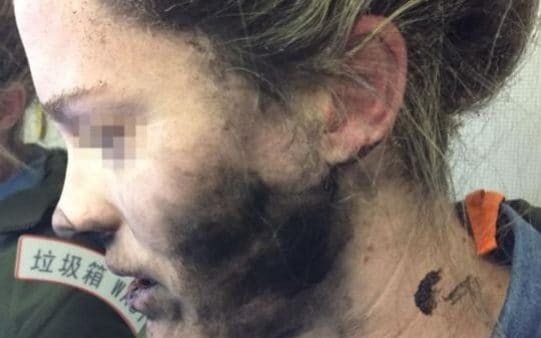 Τα ακουστικά έκαψαν το πρόσωπο γυναίκας μέσα σε αεροπλάνο