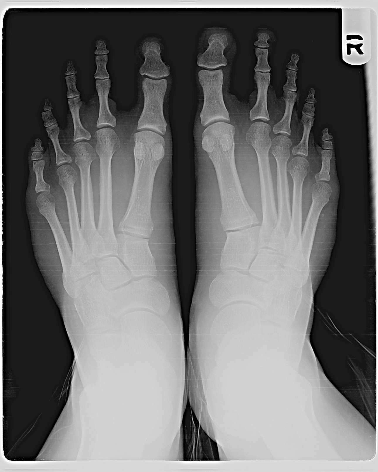 Mortons_Toe_XRay-Cjottawa -wiki