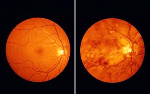 retinopathy