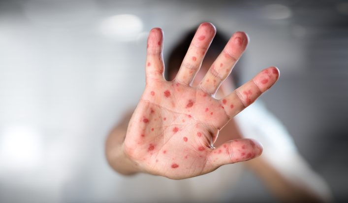 Η ιλαρά χτυπά σκληρά και την Ελλάδα