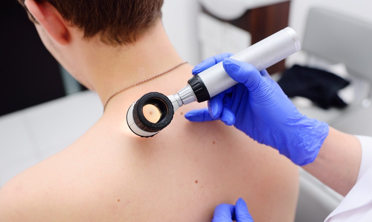 Η πρώτη εξέταση αίματος που εντοπίζει εγκαίρως το μελάνωμα