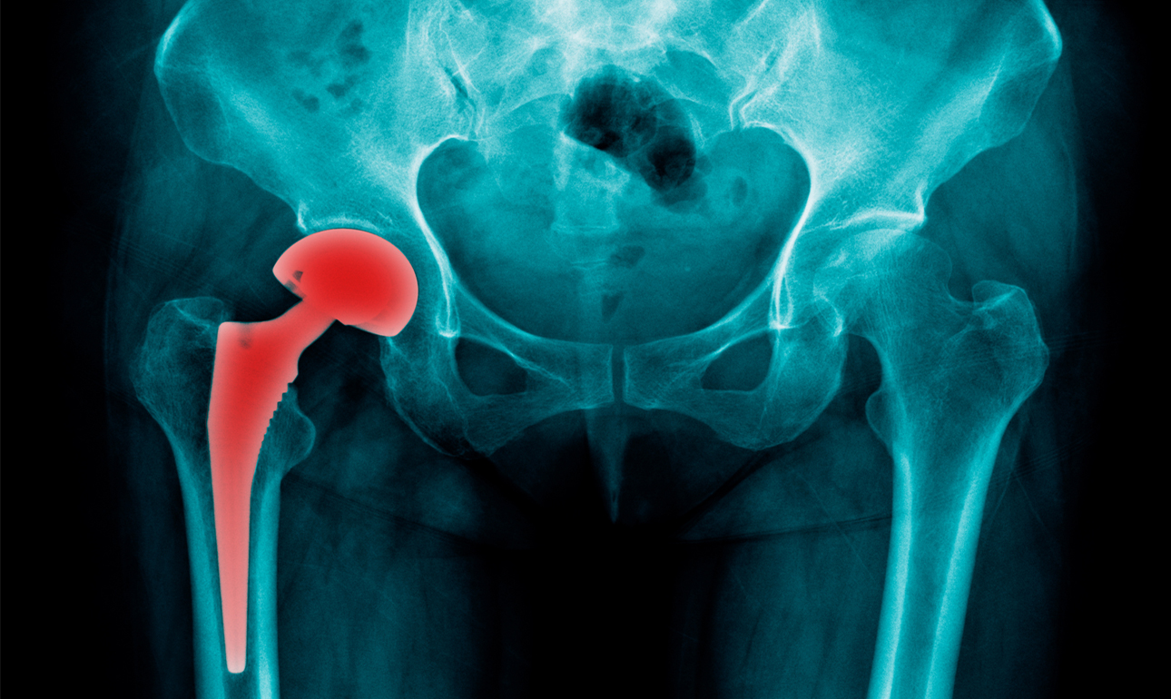 Διεθνές σκάνδαλο: Πρόσθετα και εμφυτεύματα που αντί να σώζουν σκοτώνουν