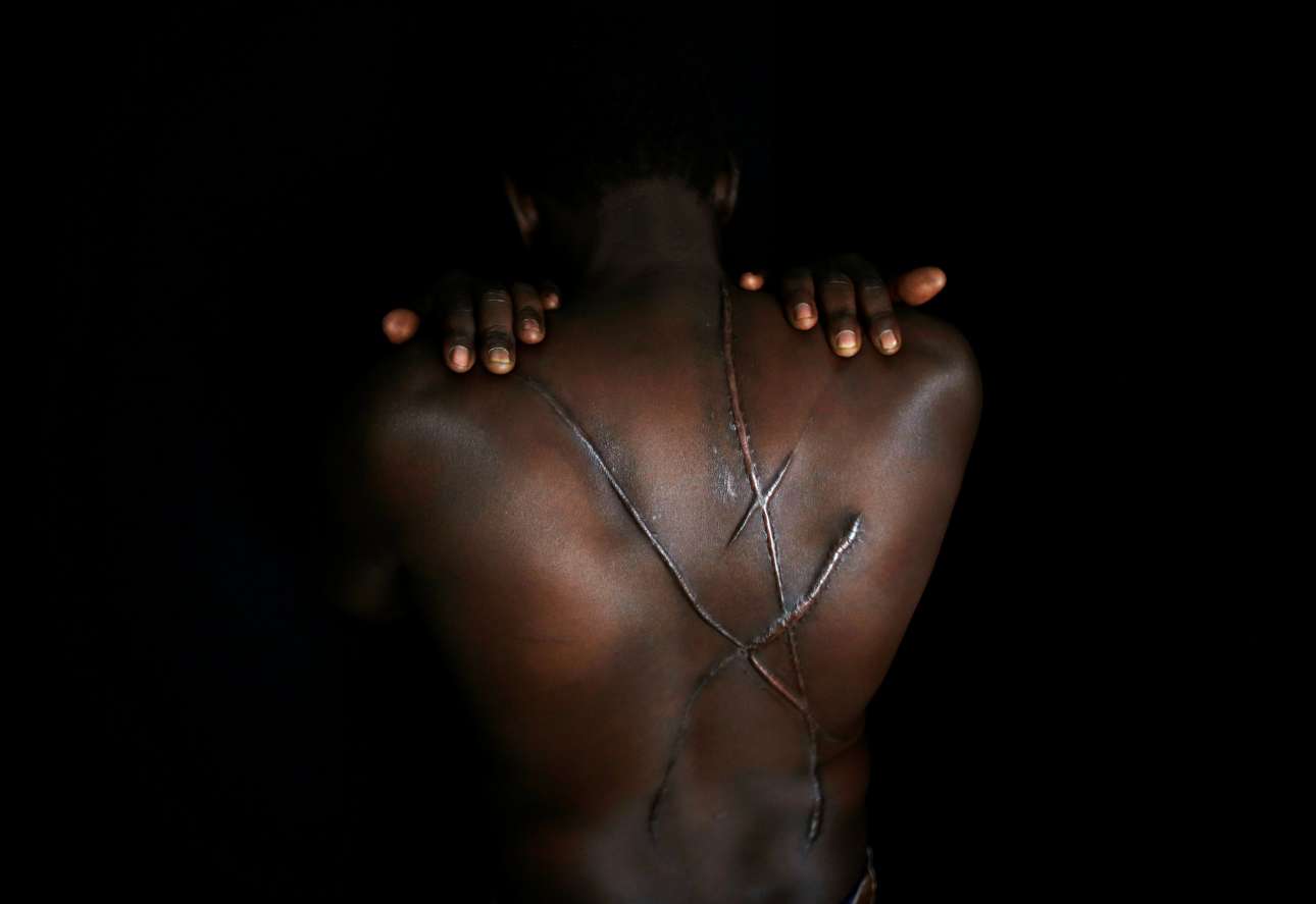 Άλλη μια πτυχή της ελληνικής κρίσης: Οι πληγές στο σώμα μετανάστη από το Σουδάν που προκάλεσαν χρυσαυγίτες, τον Αύγουστο του 2012