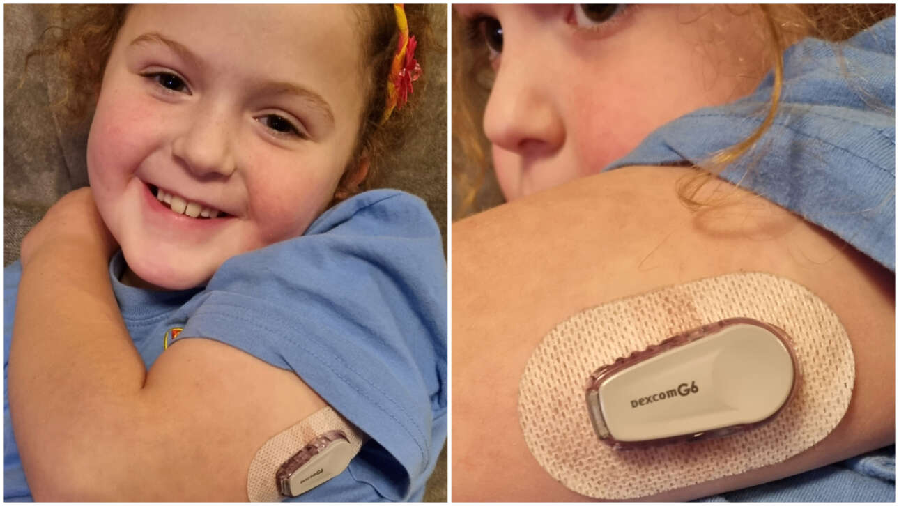 Βρετανία: Τεχνητό πάγκρεας σε εκατοντάδες ασθενείς με διαβήτη τύπου 1