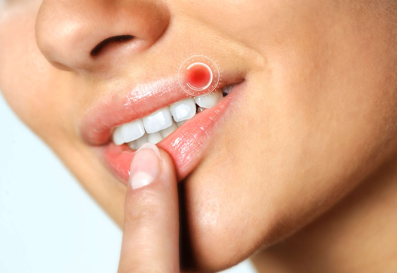 Ο επιχείλιος έρπης εξαπλώθηκε παντού από ένα αρχικό φιλί