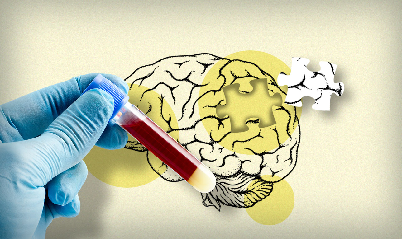 Στα αστροκύτταρα… κρύβεται το μυστήριο του Αλτσχάιμερ