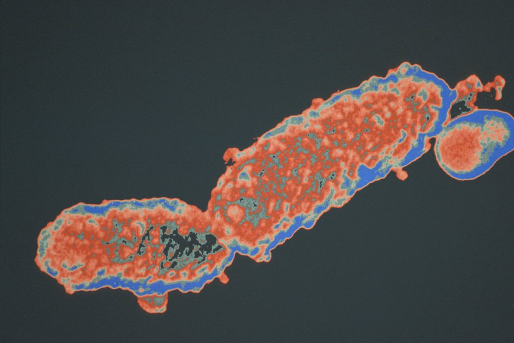 Εκρηξη κρουσμάτων κοκκύτη στην Ευρώπη – Εκκληση ECDC για εμβολιασμό