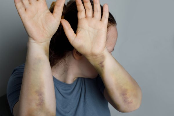 Η ενδοοικογενειακή βία δεν έχει τέλος – άγριος ξυλοδαρμός 40χρονης από τον σύντροφό της